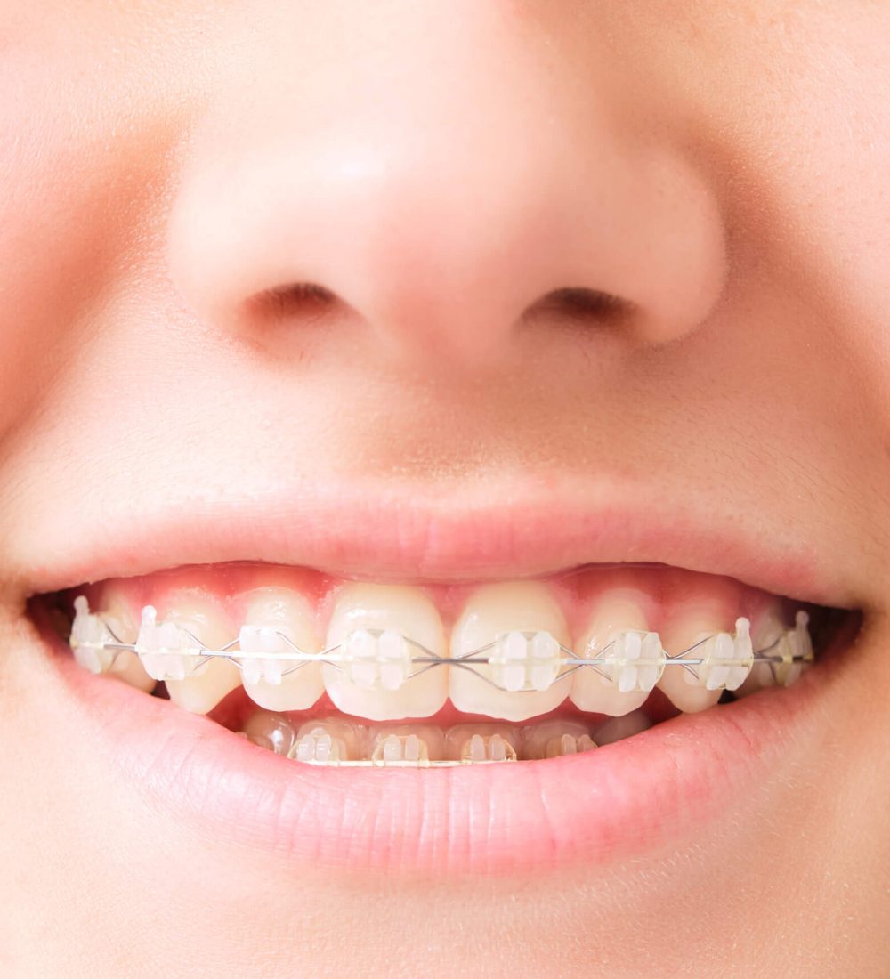 smiling-mouth-with-dental-aligner-2025-01-08-14-19-36-utc (1)